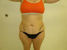 bedo b 1 Before and After Gallery