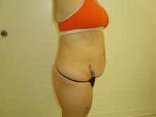 bedo b 2 Before and After Gallery