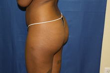 deru b 2 Before and After Gallery