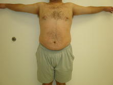 joem a 1 Before and After Gallery