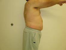 joem a 2 Before and After Gallery
