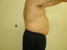 joem b 2 Before and After Gallery