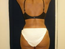 johm a 3 Before and After Gallery