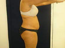 johm b 2 Before and After Gallery