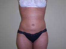 lefu a 1 Before and After Gallery
