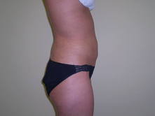 lefu a 2 Before and After Gallery