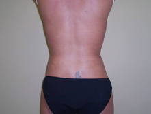 lefu a 3 Before and After Gallery