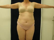 nawh b 1 Before and After Gallery