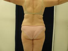 nawh b 3 Before and After Gallery