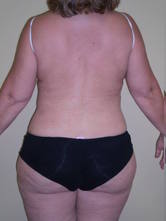 reyn a 3 Before and After Gallery