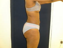soha a 1 Before and After Gallery