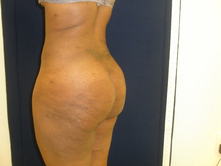 soha a 2 Before and After Gallery