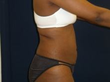 soha b 1 Before and After Gallery