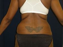 soha b 3 Before and After Gallery