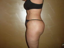 sume a 2 Before and After Gallery