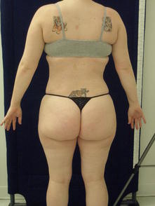 titr a 3 Before and After Gallery