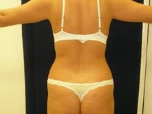 trdr b 3 Before and After Gallery