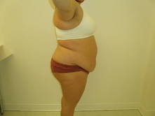 trqu b 2 Before and After Gallery