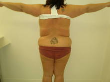 trqu b 3 Before and After Gallery