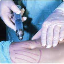 Liposuction Techniques